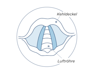 Flüsterstimme - Abduktor- Typ der laryngealen Dystonie