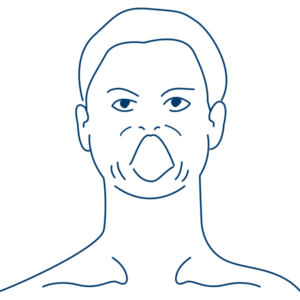 Kieferkrampf und Zungenkrampf sind Smptome bei Oromandibuläre Dystonie